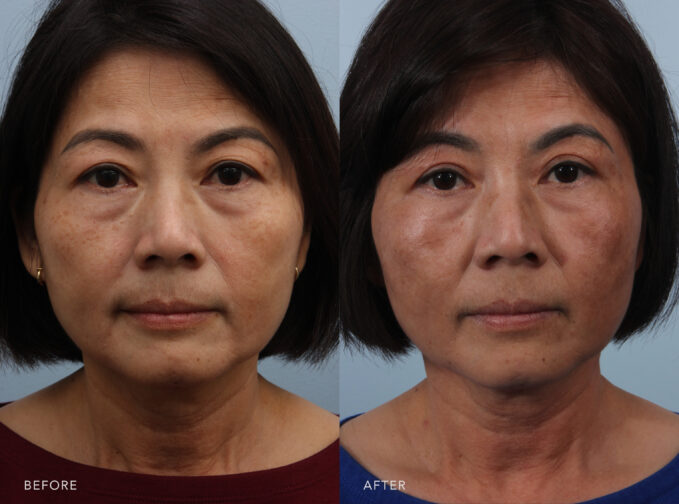 A photo of a woman's face before and after the Upper Blepharoplasty procedure. Before photo shows concerns about excess skin on her upper eyelids, drooping over her eyelid crease and extending to her eyelashes. The after photo shows removed excess skin that previously drooped over her eyelid, giving the upper eyelids a lifted and firmer appearance. | Albany, Latham, Saratoga NY, Plastic Surgery