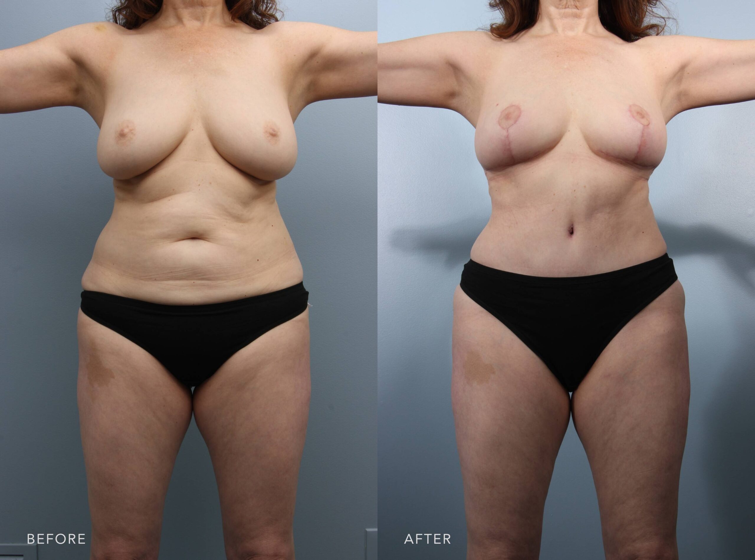 A photo of a woman's body before and after the Breast Lift and Tummy Tuck w/ Liposuction procedure. The before photo shows an out-of-proportion body, with drooping breasts and a loose midsection. The after photo shows a balanced and rejuvenated silhouette, with improved proportions between her chest, waist, and hips. | Albany, Latham, Saratoga NY, Plastic Surgery