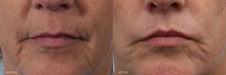 Lip lift Albany, Latham, Saratoga NY contour. | Albany, Latham, Saratoga NY, Plastic Surgery