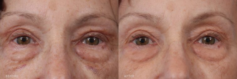 A photo of a woman's upper face before and after the Bilateral Brow Lift procedure. The before photo shows low-set, drooping eyebrows sitting below or directly on the brow bone, contributing to a heavy or hooded upper eyelid appearance. The after photo shows resting at or slightly above the brow bone, enhancing the shape and openness of her eyes. | Albany, Latham, Saratoga NY, Plastic Surgery