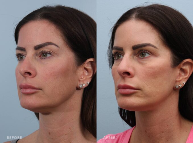 A side-by-side view of a woman's face before and after the Deep Plane Facelift, Upper Blepharoplasty, Lower Blepharoplasty & Fat Grafting procedure. The before photo shows mild hooding and heaviness in her upper eyelids, giving a tired appearance. The after photo shows more open and lifted upper eyelids, resulting in a refreshed and alert look without looking overdone. | Albany, Latham, Saratoga NY, Plastic Surgery