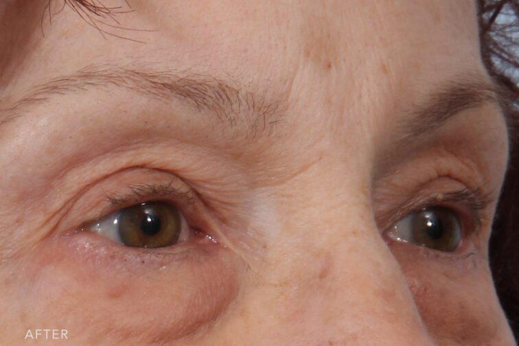 A photo of a woman's upper face shows open, wide, and expressive eyes, free from shadowing or heaviness. | Albany, Latham, Saratoga NY, Plastic Surgery