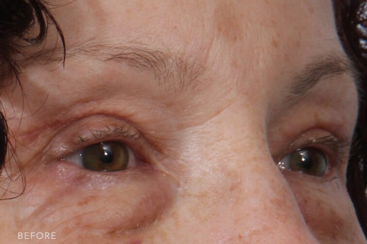 A photo of a woman's upper face shows a weighed-down upper eyelids, creating a shadowed, closed-off look to her eyes. | Albany, Latham, Saratoga NY, Plastic Surgery