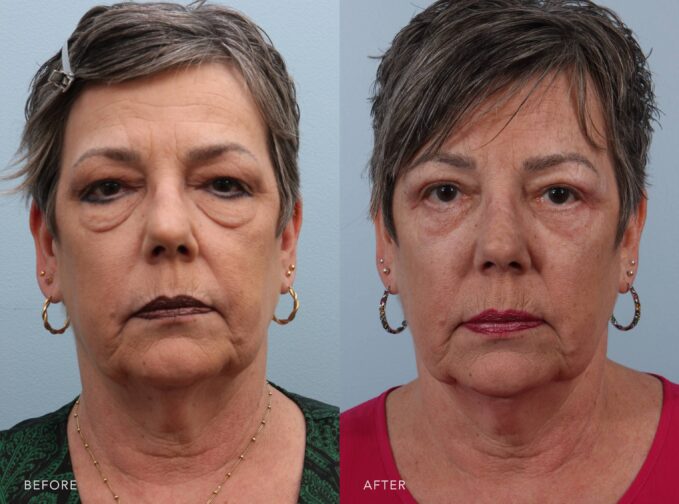 A photo of a woman's face before and after the Lower Blepharoplasty and Upper Blepharoplasty procedure. The before photo shows under-eye bags, marked puffiness, and fullness beneath both eyes, contributing to a consistently heavy and fatigued appearance. The after photo shows smooth, well-contoured lower eyelids, free from visible under-eye bags or puffiness. The area beneath both eyes appears firm and evenly blended with the upper cheeks, contributing to a refreshed, rested, and youthful appearance. | Albany, Latham, Saratoga NY, Plastic Surgery
