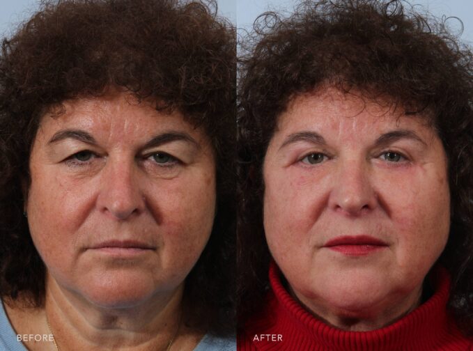 A photo of a woman's face before and after the Excision of Excess Upper Eyelid Skin and Lower Eyelid Bilateral Blepharoplasty procedure. The before photo shows the presence of lower eyelid bags, mild wrinkling, and skin redundancy below her eyes, contributing to a tired and puffy look. The after photo shows a smooth, firm, and taut lower eyelid contour, with no visible puffiness, wrinkling, or excess skin beneath her eyes, contributing to a refreshed, rested, and youthful appearance. | Albany, Latham, Saratoga NY, Plastic Surgery