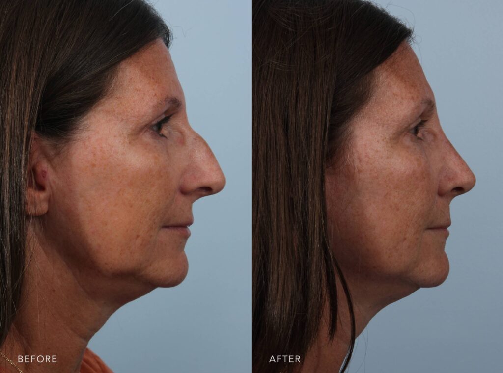 A side-by-side view of a woman's face before and after the Cosmetic Rhinoplasty procedure. The before photo shows a slightly downward nasal tip, creating a drooping effect that extends the overall length of the nose in profile, causing the nose to appear more pronounced and heavy, especially when viewed from the side. The after photo shows a gently lifted nasal tip that maintains a natural, upward angle, contributing to a shorter, more refined nasal profile. The tip appears light and well-supported, helping the nose blend harmoniously with the rest of the facial features. | Albany, Latham, Saratoga NY, Plastic Surgery.