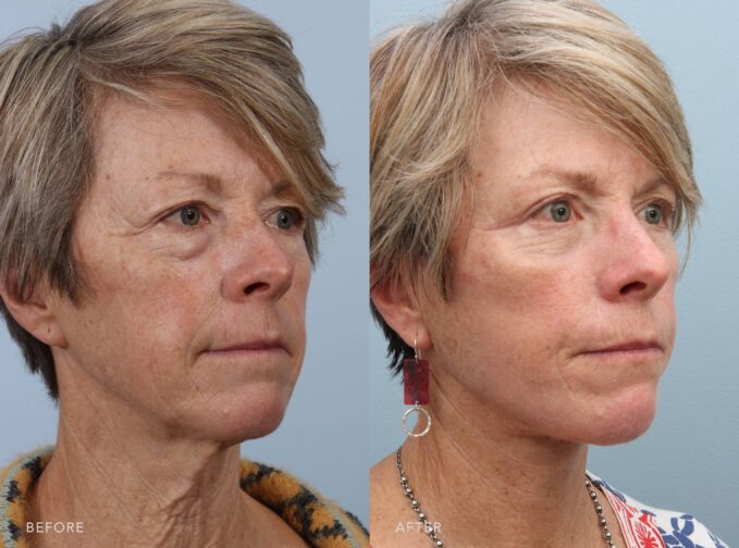 A side-by-side view of a woman's face before and after the Deep Plane Facelift and Upper Blepharoplasty procedure. The before photo shows noticeable puffiness and under-eye bags, giving her eyes a tired, heavy appearance. The after photo shows smooth, refreshed under-eye areas, giving her eyes a bright, youthful, and well-rested appearance. | Albany, Latham, Saratoga NY, Plastic Surgery