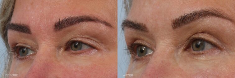 A side-by-side view of a woman's face before and after the Upper Blepharoplasty procedure. The before photo shows an overhanging skin that compresses the eyelid area, making her eyes appear smaller and the brow-to-lash distance much shorter. The after photo shows well-defined upper eyelids with no overhanging skin, creating a balanced and open brow-to-lash distance. | Albany, Latham, Saratoga NY, Plastic Surgery