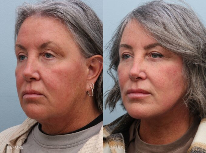A side-by-side view of a woman's face before and after the Deep Plane Lower Face and Neck Lift Procedure. The before photo shows weighed-down facial features, with her cheeks and jawline losing their crisp edges and the skin appearing subtly deflated. The after photo reveals lifted, well-supported facial features, with her cheeks appearing fuller and naturally elevated and her jawline restored to a crisp, youthful contour. The skin looks firm and revitalized, enhancing her overall expression. | Albany, Latham, Saratoga NY, Plastic Surgery