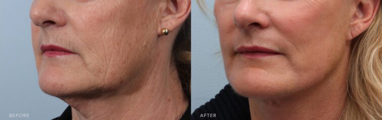 A side-by-side view of a woman's photo before and after the Deep Plane Facelift, Submental Liposuction, Upper Blepharoplasty, Lower Blepharoplasty, Brow Lift, Fat Grafting & TCA peel procedure. The before photo shows the skin around her mouth and lower cheeks displaying coarse wrinkling and uneven texture, consistent with age-related collagen degradation. The after photo shows softened fine lines with a smooth, radiant texture around her mouth and lower cheeks. | Albany, Latham, Saratoga NY, Plastic Surgery