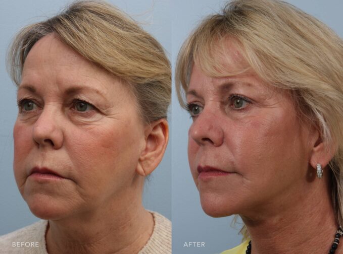 A side-by-side view of a woman's face before and after the Deep Plane Facelift, Upper Blepharoplasty, Lower Blepharoplasty, and Fat Grafting procedure. The before photo displays horizontal creases and texture irregularities that are visible across her neck, giving the skin a lined and uneven appearance. Alongside the lines, her skin shows patchy roughness, subtle ridges, or thinning areas that disrupt the smoothness of her neck. The after photo shows a smooth, even-toned neck with no visible horizontal creases or texture irregularities. The skin appears firm, well-hydrated, and supple, with a consistent surface that reflects light evenly. | Albany, Latham, Saratoga NY, Plastic Surgery