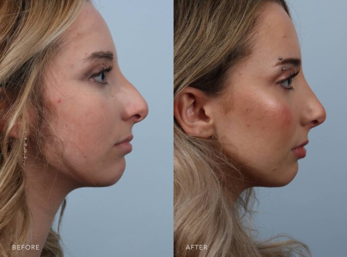 A photo of a woman's face before and after the Cosmetic Rhinoplasty procedure. The before photo shows a downward orientation of her nasal tip, causing the nose to appear longer from a profile or base view and resulting in weakened or elongated lower lateral cartilages. The after photo shows an upward orientation of her nasal tip, creating a shorter and more refined appearance from the profile or base view, indicating strengthened and well-supported lower lateral cartilages. | Albany, Latham, Saratoga NY, Plastic Surgery