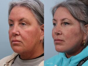 A side-by-side view of a woman's face before and after the Deep Plane Lower Face and Neck Lift Procedure. The before photo shows weighed-down facial features, with her cheeks and jawline losing their crisp edges and the skin appearing subtly deflated. The after photo reveals lifted, well-supported facial features, with her cheeks appearing fuller and naturally elevated and her jawline restored to a crisp, youthful contour. The skin looks firm and revitalized, enhancing her overall expression. | Albany, Latham, Saratoga NY, Plastic Surgery