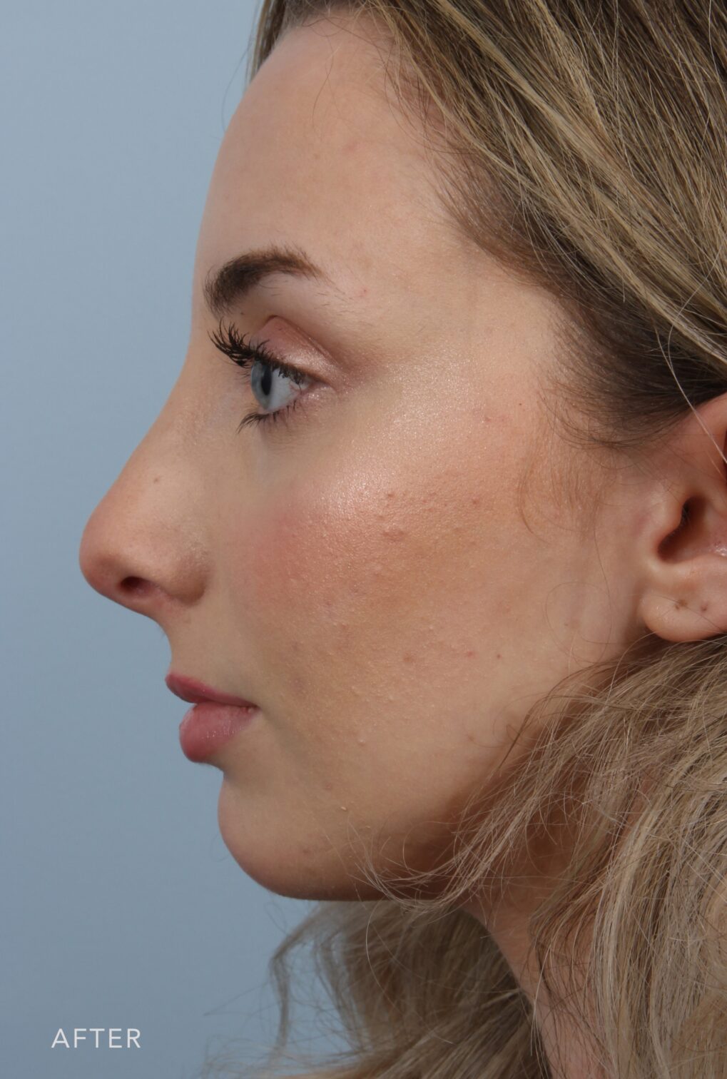 Rhinoplasty & Nasal Reconstruction Gallery | The Williams Center ...