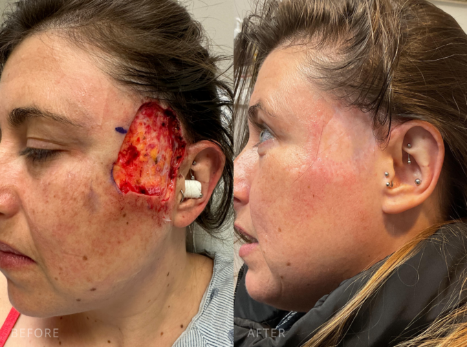 Female patient before and after MOHs reconstruction surgery on the cheek near the ear. Left image shows post-MOHs surgical wound, right image shows fully healed results with minimal scarring.