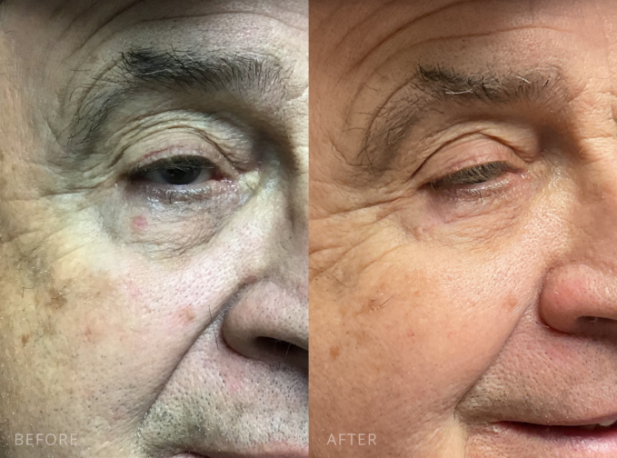 Male patient before and after MOHs reconstruction near the lower eyelid. Left image shows pre-operative skin lesion, right image shows healed results with no visible scarring.