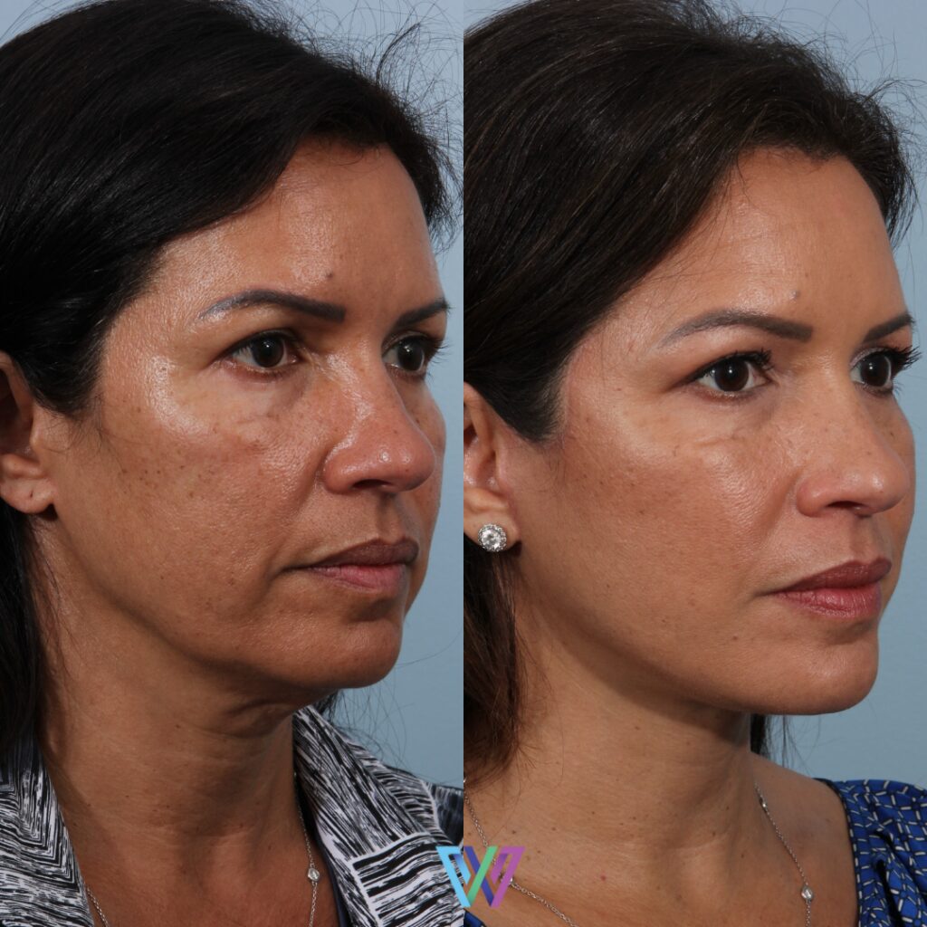 before & after | Deep plane facelift