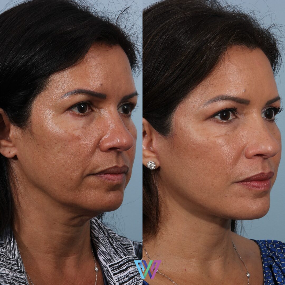before & after | Deep plane facelift