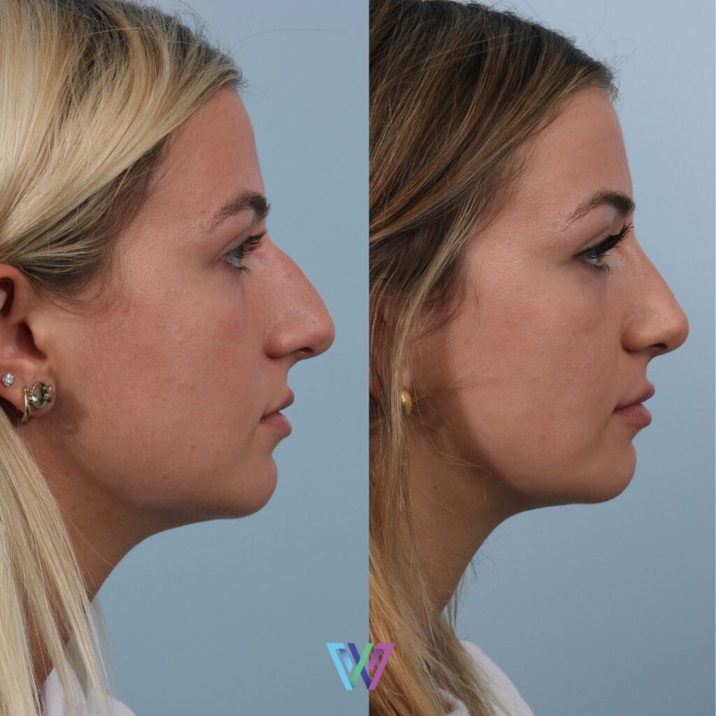 Rhinoplasty in Pittsfield before and after