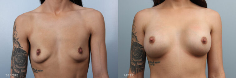 breast augmentation before and after