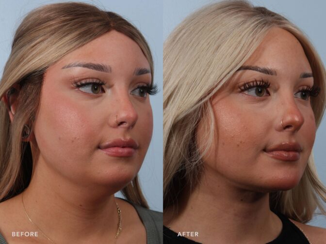 A photo of a woman's face before and after the Deep Neck Lift with Liposuction and Chin Augmentation procedure. The before photo shows a blunted and poorly defined transition between the underside of her chin and the upper neck, contributing to a heavier, less sculpted appearance of her lower face and neck. The after photo shows a sharp, well-defined transition between the underside of her chin and the upper neck, contributing to a lighter, more sculpted appearance of her lower face and neck. | Albany, Latham, Saratoga NY, Plastic Surgery