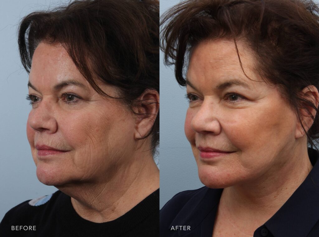 Before and after Deep Neck Lift with Chin Augmentation