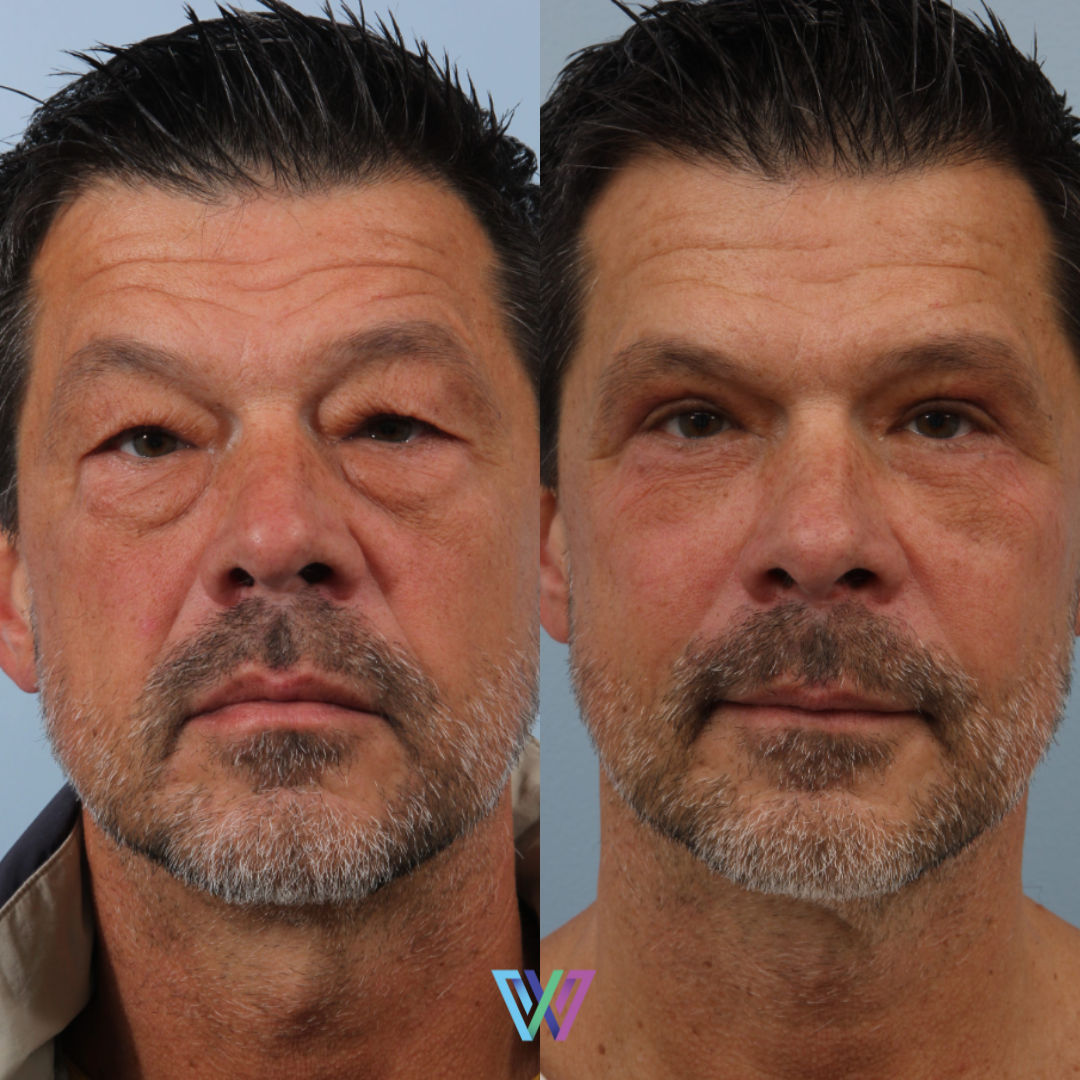 before and after photos of a blepharoplasty surgery performed by Dr. Williams