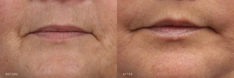 A photo of a woman's lower face before and after the Lip Lift procedure. The before photo shows fine lines and wrinkles extending from the corners of the mouth and around her lips. The after photo shows smooth skin around the mouth with no visible fine lines or wrinkles, creating a youthful and well-rested appearance. | Albany, Latham, Saratoga NY, Plastic Surgery