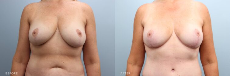 A photo of a woman's upper body before and after the Breast Lift w/ Small Reduction procedure. The before photo shows a downward migration of her breast tissue, creating a fuller, bottom-heavy contour and contributing to an elongated, pendulous breast shape. The after photo shows a rounded, uplifted contour with no signs of downward migration or bottom heaviness, maintaining a natural, perky projection. | Albany, Latham, Saratoga NY, Plastic Surgery