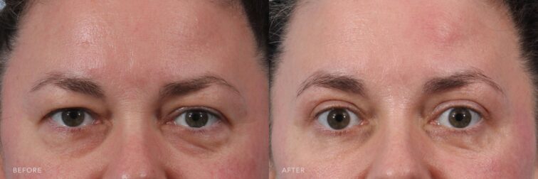 A photo of a woman's face shows before and after the Upper Blepharoplasty, Lower Blepharoplasty & Fat Transfer procedure. The before photo shows mild under-eye bags, disrupting the smooth contour of the lower eyelids, contributing to a worn-out appearance. The after photo shows well-defined lower eyelids without bulging or swelling, highlighting a smooth and youthful midface. | Albany, Latham, Saratoga NY, Plastic Surgery