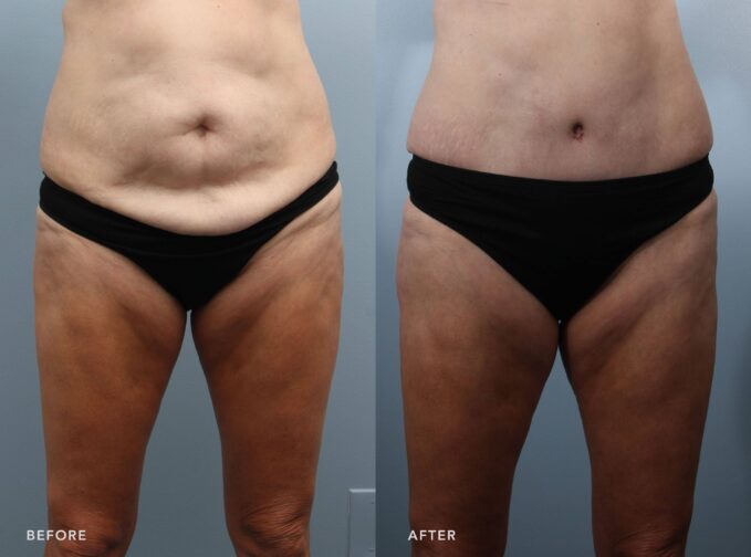 A photo of a woman's body before and after the Tummy tuck w/ liposuction back flanks and abdomen procedure. The before photo shows pronounced abdominal protrusion and central fullness, with the lower and mid-abdominal areas exhibiting significant skin laxity and redundant soft tissue. The after photo shows a flat, toned abdomen with no signs of protrusion or central fullness. The lower and mid-abdominal areas appear firm and smooth, with tight, elastic skin and no visible laxity or redundant soft tissue. | Albany, Latham, Saratoga NY, Plastic Surgery