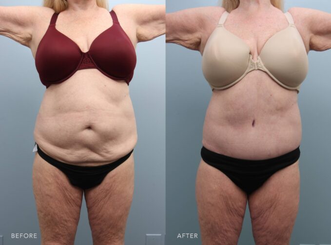 A photo of a woman's abdomen before and after the lower body lift with liposuction back flanks and abdomen procedure. The before photo shows significant skin laxity, with multiple horizontal skin folds and visibly loose, hanging tissue concentrated in her lower abdominal region, contributing to a bulky and uneven contour through the midsection, creating a softened, aged appearance across the abdomen. The after photo shows smooth, firm skin with no visible laxity or folds. The lower abdominal region appears tight and well-contoured, creating a flat, youthful, and balanced midsection. | Albany, Latham, Saratoga NY, Plastic Surgery