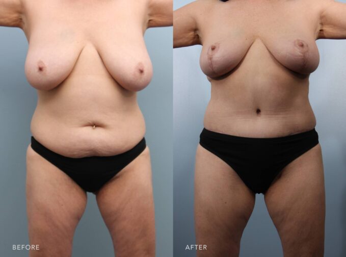 A photo of a woman body before and after the Tummy Tuck w/ Lipo Back Blanks Abdomen and Bilateral Lateral Chest Wall. The before photo shows prominent central and lower abdominal fullness, characterized by a substantial subcutaneous adipose tissue accumulation throughout her midsection. The after photo shows a flat, well-contoured abdomen with no evidence of central or lower abdominal fullness, enhancing the natural waistline and providing a balanced, sculpted appearance to her torso. | Albany, Latham, Saratoga NY, Plastic Surgery