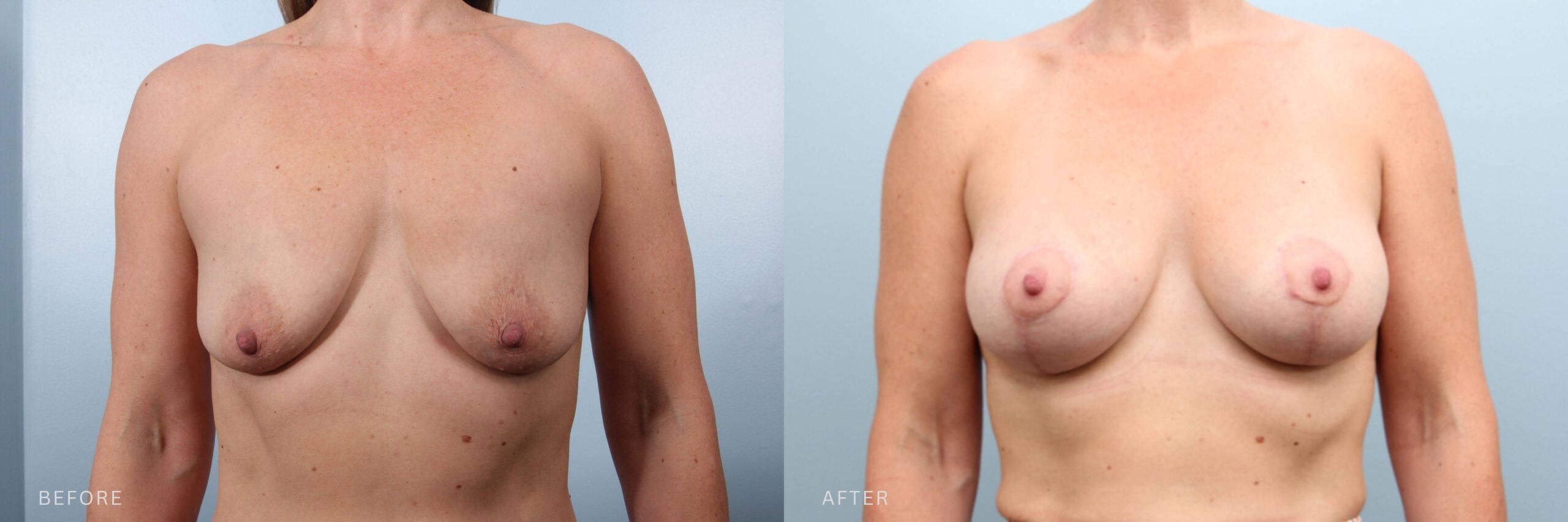 A photo of a woman's body before and after the Breast Augmentation and lift with implants procedure. The before photo shows a stretched, downward-drifting breast appearance, with little structural support or volume in the upper chest region. The after photo shows full, elevated breasts with a round, compact shape and balanced volume distribution, giving the appearance of firm structural support and youthful projection. | Albany, Latham, Saratoga NY, Plastic Surgery