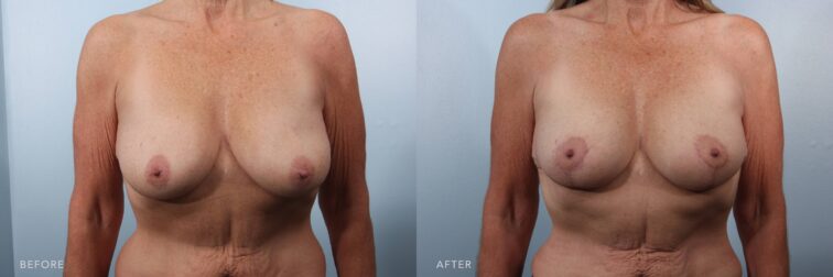 A photo of a woman's body before and after the Breast Lift and Fat Transfer to Breasts procedure. The before photo exhibits volume loss and deflation on the upper [ples of her breasts, while most of the breast tissue has migrated to the lower pole, creating a pendulous appearance. The after photo shows well-distributed breast volume, with noticeable fullness in the upper poles and a rounded, uplifted contour. The breast tissue is evenly positioned, maintaining a balanced shape between the upper and lower poles, avoiding any pendulous or bottom-heavy appearance. | Albany, Latham, Saratoga NY, Plastic Surgery