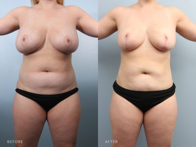 A photo of a woman's body before and after the Breast Reduction, Chest Wall Lipo, Lipo Back, Flanks, Abdomen procedure. The before photo shows visible fullness along the outer chest and upper flanks with soft tissue extending laterally beneath the arms and around the bra line. The after photo shows a smooth, contoured transition along the outer chest and upper flanks, with no visible fullness or bulging beneath the arms or around the bra line. | Albany, Latham, Saratoga, NY, Plastic Surgery