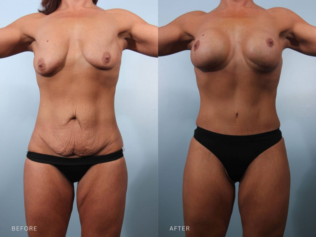 A photo of a woman's body before and after the Mommy Makeover procedure. The before photo shows a toned torso, with minimal muscular contour visible across the chest and shoulders, giving the body a more relaxed, less sculpted look. The after photo shows a well-toned torso, with clearly defined muscular contours across the chest and shoulders, giving the body a firm, athletic, and sculpted appearance. | Albany, Latham, Saratoga NY, Plastic Surgery