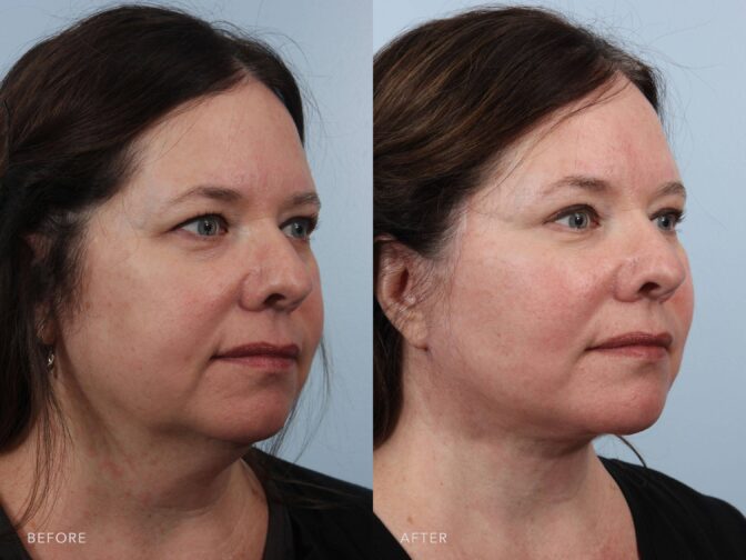 A side-by-side view of a woman's face before and after the Deep Plane Lower Face and Neck Lift procedure. The before photo shows a gentle heaviness in the lower cheeks, giving the face a less lifted and slightly more mature appearance. The after photo shows softly lifted lower cheeks, enhancing facial definition and contributing to a youthful, refreshed appearance. | Albany, Latham, Saratoga NY, Plastic Surgery