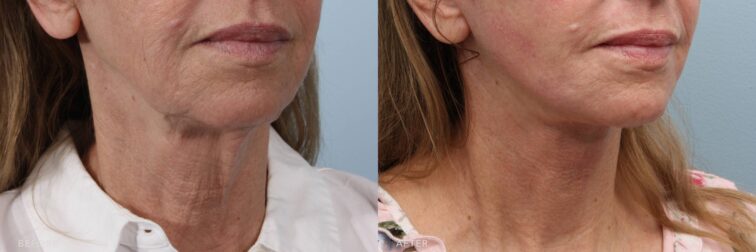 A side-by-side view of a woman's lower face before and after the Deep Plane Facelift and TCA Peel procedure. The before photo shows loss of angular definition beneath her jaw, contributing to a heavier lower face profile. The after photo shows a structured and elevated lower face profile, with precise jawline angles and minimal bulk. | Albany, Latham, Saratoga NY, Plastic Surgery
