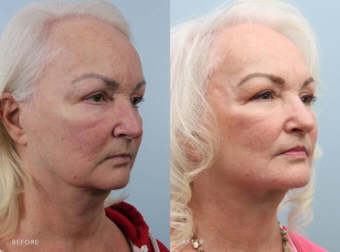 A side-by-side view of a woman's photo before and after the Deep Plane Facelift, Lip Lift, and TCA Peel procedure. The before photo shows loosened skin in the neck, accompanied by banding that softens its definition and creates an aged look. The after photo shows a smooth, firm neck with no visible banding. The skin appears taut and well-supported, enhancing a youthful, contoured look. | Albany, Latham, Saratoga NY, Plastic Surgery