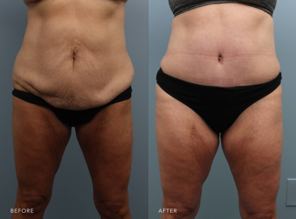 A photo of a woman's abdomen before and after Tummy tuck w/ liposuction procedure. The before photo shows pronounced skin laxity with deep wrinkling and sagging, concentrated in her lower region beneath the belly button. The after photo reveals smooth, taut skin with no visible wrinkling or sagging, and a firm, well-contoured appearance throughout the lower region beneath the belly button. | Albany, Latham, Saratoga NY, Plastic Surgery