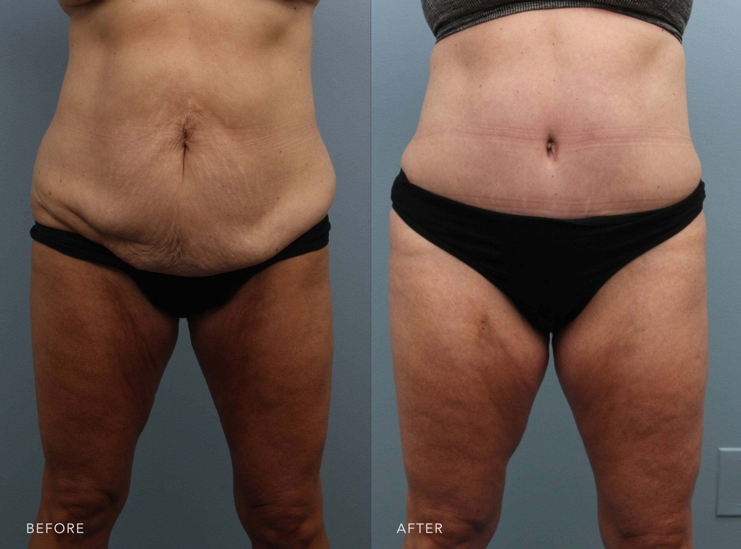 lipo during c section Abdominoplasty After C-Section