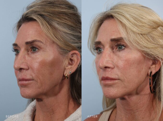 A side-by-side view of a woman's face before and after the Deep Plane Lower Face and Neck Lift procedure. The before photo shows noticeable nasolabial folds and marionette lines, with skin texture that looks mildly uneven and etched with fine lines. The after photo shows smooth, even skin with barely visible nasolabial folds or marionette lines and no noticeable fine lines. | Albany, Latham, Saratoga NY, Plastic Surgery