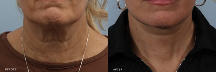 A photo of a woman's lower face before and after the Lower Face and Neck Lift procedure. The before photo displays visible signs of skin laxity, with loose, sagging skin creating a softened and aged contour. The after photo reveals firm, smooth skin with a well-defined, youthful contour. Her skin appears tight and lifted, with no visible signs of sagging or looseness, maintaining a fresh, sculpted appearance. | Albany, Latham, Saratoga NY, Plastic Surgery