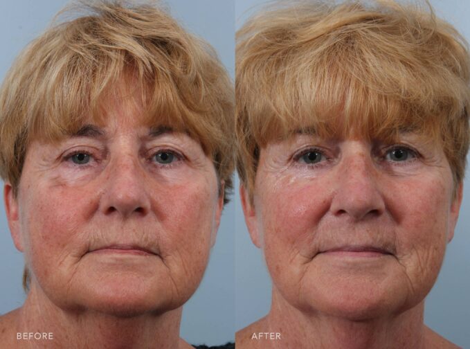 A photo of a woman's face before and after the Reconstruction of MOHs Right Lower Eyelid procedure. The before photo shows eyelid tissue loss from Mohs excision, leaving an irregular surface and visible defect beneath the eye. The after photo shows intact and natural, with even contour and no signs of tissue loss or irregularity. | Albany, Latham, Saratoga NY, Plastic Surgery