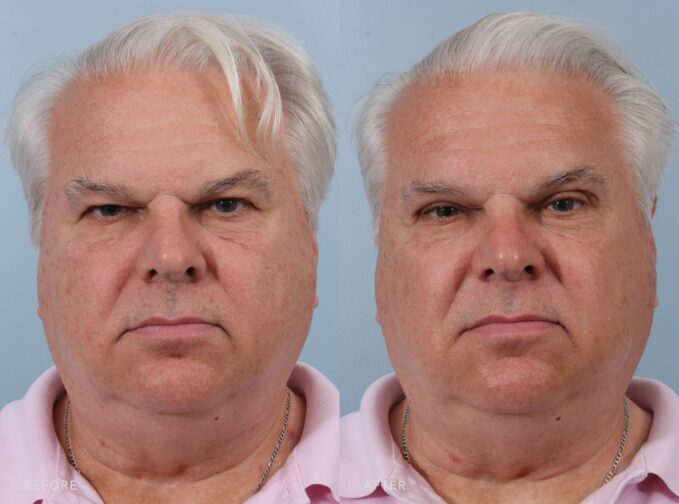 A photo of a man's face before and after the Brow Lift & Upper Eyelid Blepharoplasty procedure. The before photo shows dermatochalasis with redundant skin draping over the natural lid crease on his upper eyelid. The after photo shows a smooth, defined contour. The redundant skin has been removed, revealing a visible natural lid crease. The eyelid appears lifted and more open, giving a refreshed and youthful look. | Albany, Latham, Saratoga NY, Plastic Surgery