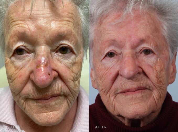 A photo of a woman's face before and after the Mohs excision. The before photo shows a fresh surgical defect with redness and a small scabbed area in her nasal bridge. The surrounding tissue appears slightly swollen, highlighting the recent excision site. The after photo shows a fully healed nasal bridge, with smooth and even skin. There is no visible scab, redness, or swelling, and the area blends naturally with the surrounding tissue. | Albany, Latham, Saratoga NY, Plastic Surgery