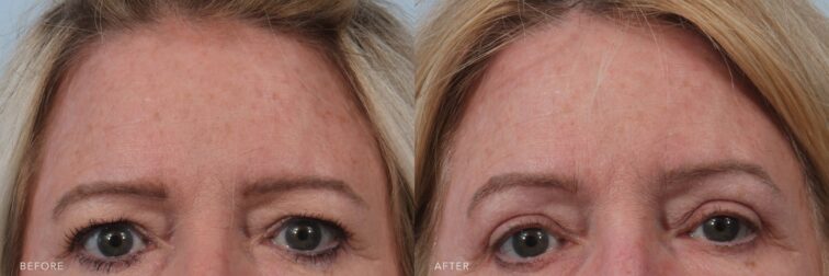A photo of a woman's face before and after the Brow and Upper Lid Ptosis procedure. The before photo shows noticeable drooping of the upper eyelids, creating a heavy, fatigued appearance. The after photo shows well-positioned, lifted upper eyelids, giving her eyes a bright, refreshed, and youthful appearance. | Albany, Latham, Saratoga NY, Plastic Surgery