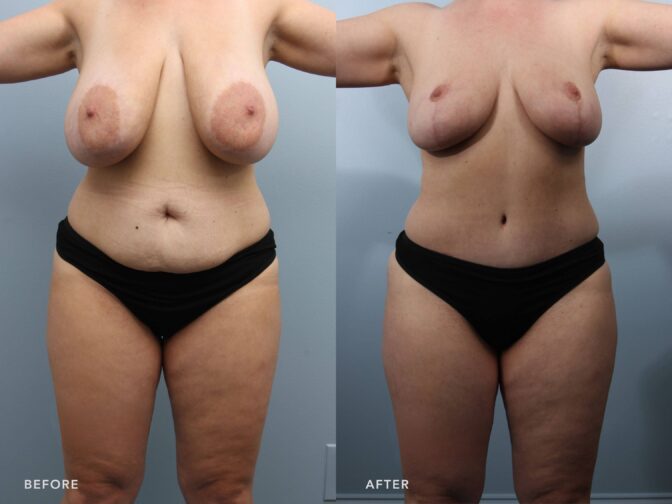 A photo of a woman's body before and after the Bilateral Breast Reduction, Abdominoplasty w/ Liposuction Back Flanks, and Abdomen procedure. The before photo displays markedly enlarged, pendulous breasts with pronounced ptosis, with the lower poles of her breasts extending well below the inframammary folds. The after photo displays well-proportioned, elevated breasts with a youthful contour. The breast tissue sits firmly above the inframammary folds, with no signs of ptosis or excess sagging. The nipple-areola complexes are positioned centrally on the breast mound, contributing to a balanced and lifted appearance. | Albany, Latham, Saratoga NY, Plastic Surgery