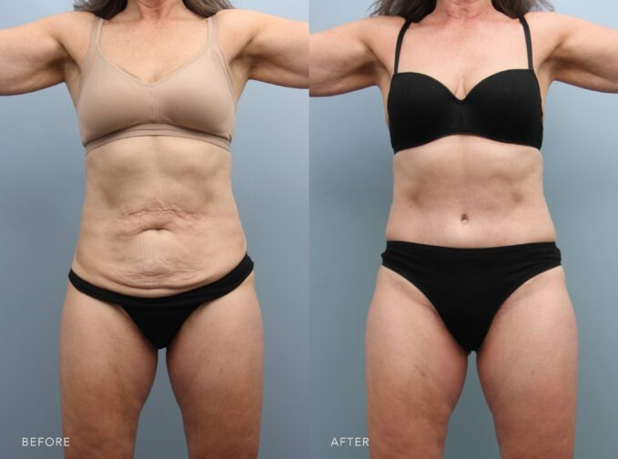 A photo of a woman's body before and after the Tummy Tuck w/ Lipo procedure. The before photo shows stretched, loose skin with folds in the lower belly, giving the midsection a drooping and aged appearance. The after photo shows smooth, tightened skin with no folds, giving the midsection a firm, youthful, and toned appearance. | Albany, Latham, Saratoga NY, Plastic Surgery
